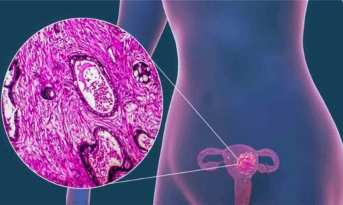 Detección oportuna: cómo se forma el cáncer cervicouterino
